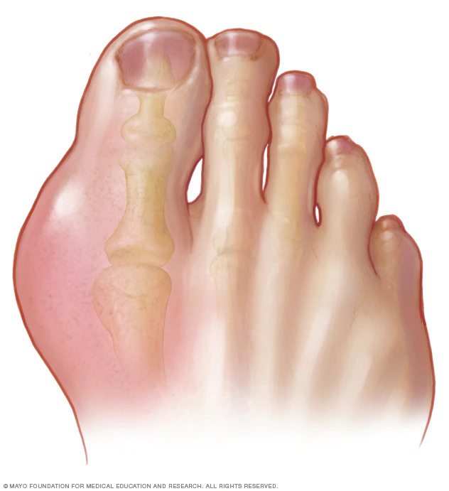 Illustration showing gout in the big toe 
